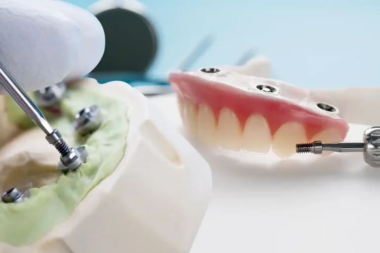 Dental Implants in Milton FL