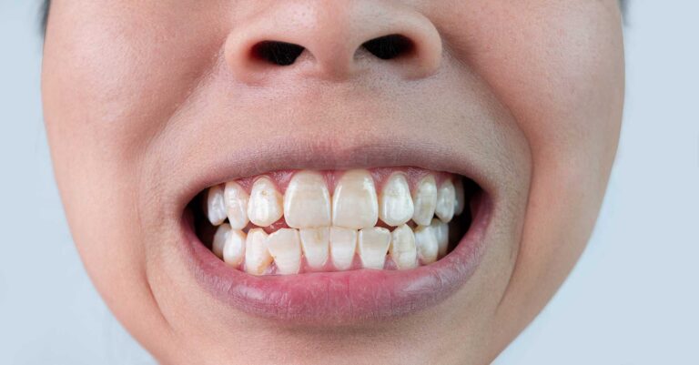 Person with White Spot on Teeth