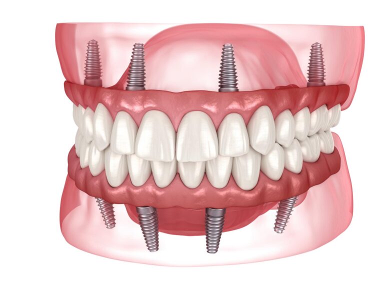 Dental Implants 3D Illustration