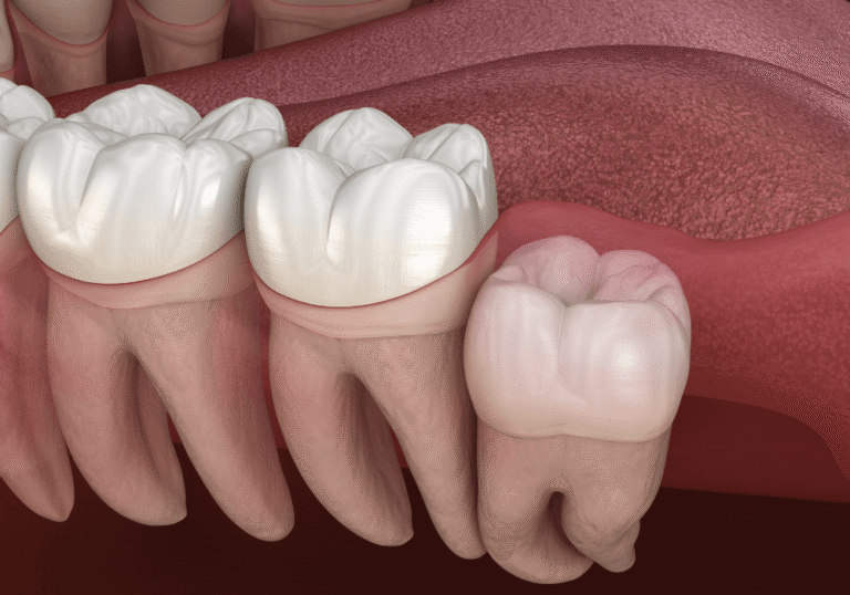 3D rendering of an impacted wisdom tooth growing at an angle and pressing against healthy molars