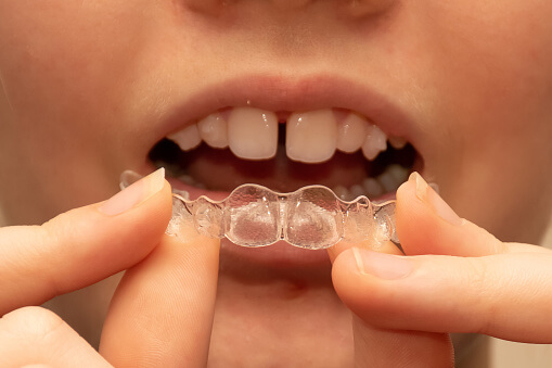 person with teeth gap using clear aligners